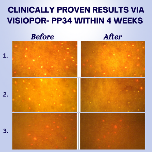 before (T₀) and after (T₁) results of skincare treatment, highlighting reduced porphyrin fluorescence and improved skin clarity.