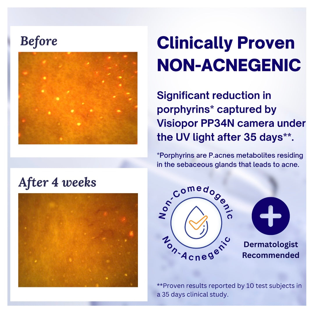 JASH'IN'CAYR Acne Control Moisturiser for Blemish Relief & Pore Control